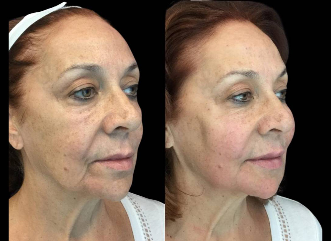 68-year-old-female-non-surgical-facelift-before-and-after-1.jpg