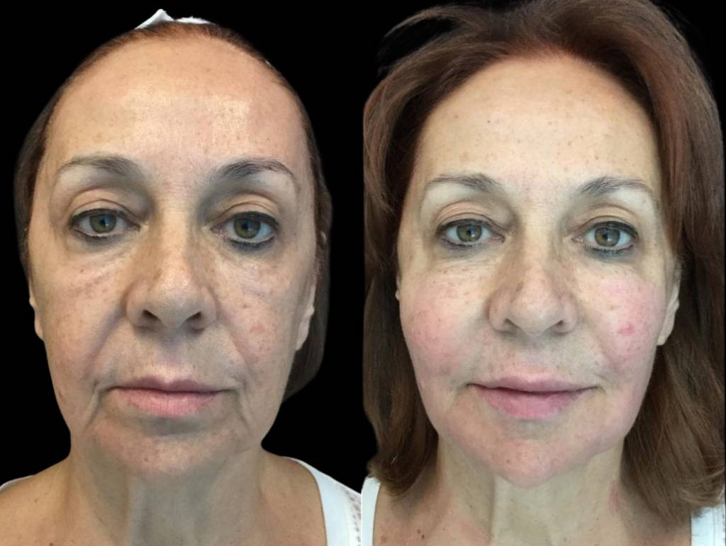68-year-old-female-non-surgical-facelift-before-and-after.jpg