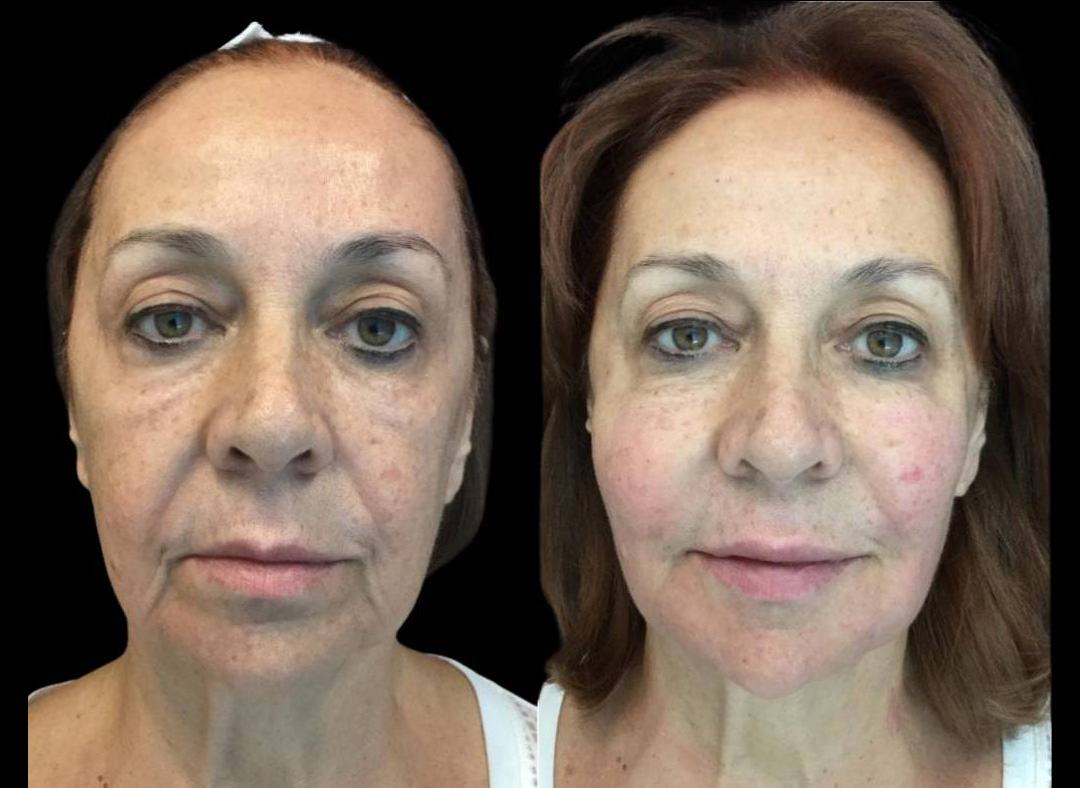 68-year-old-female-non-surgical-facelift-before-and-after.jpg