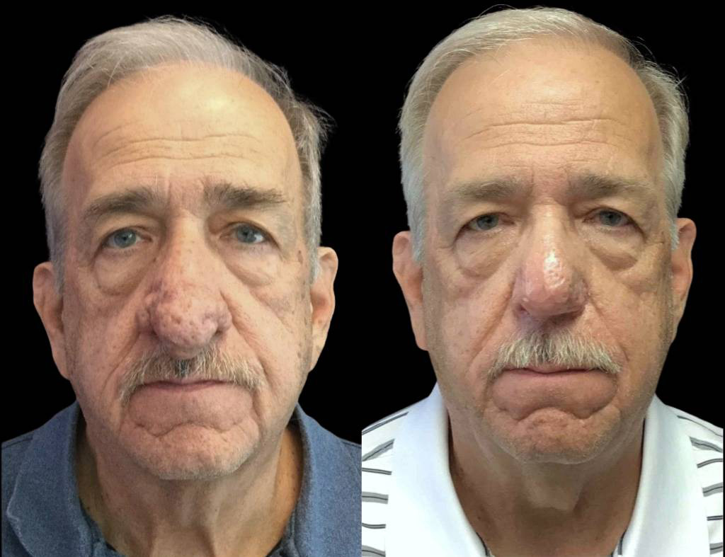 68-year-old-male-dermabrasian-before-and-after-front-view.jpg