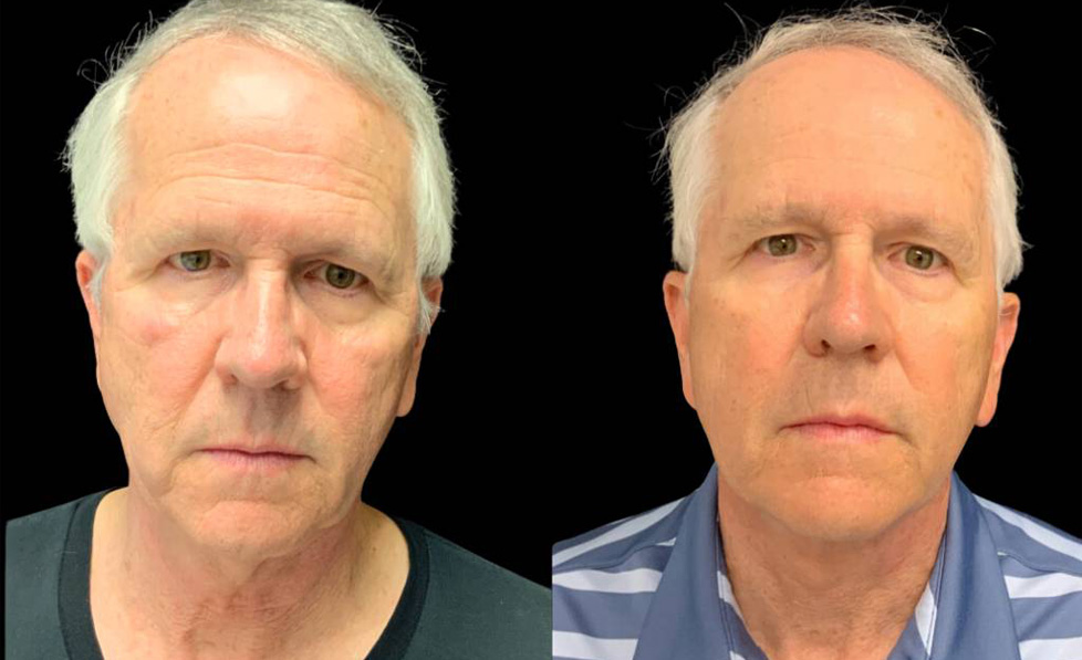 68-year-old-male-necklift-before-and-after-front-view.jpg