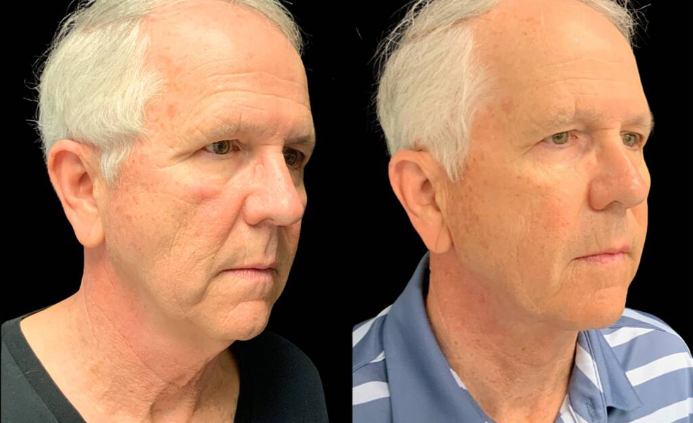 68-year-old-male-necklift-before-and-after-three-quarter-view.jpg