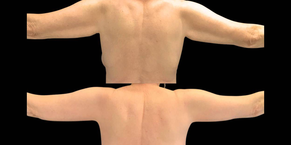 This is a 69-year-old female that has had an arm lift after weight loss showing the before and after's side-by-side