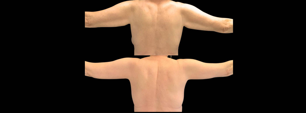 This is a 69-year-old female that has had an arm lift after weight loss showing the before and after's side-by-side