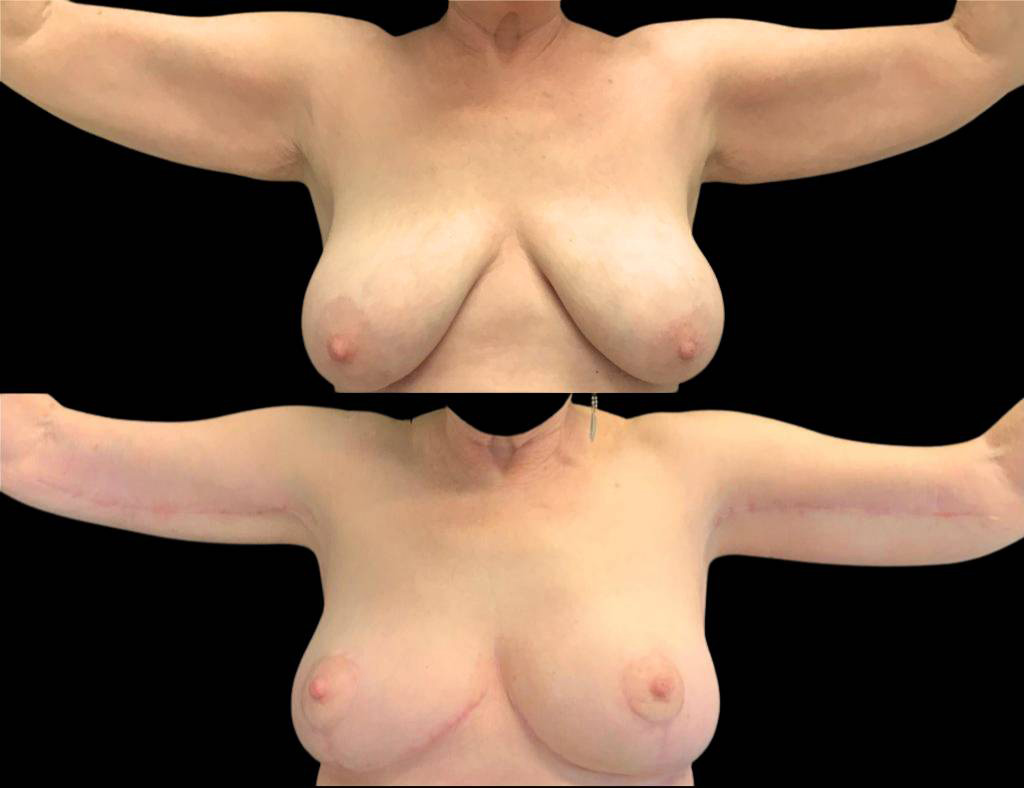 This is a 69-year-old female that has had an arm lift after weight loss showing the before and after's side-by-side