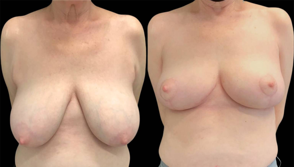 69-year-old-female-breast-implant-exchange-before-and-after-front-view.jpg