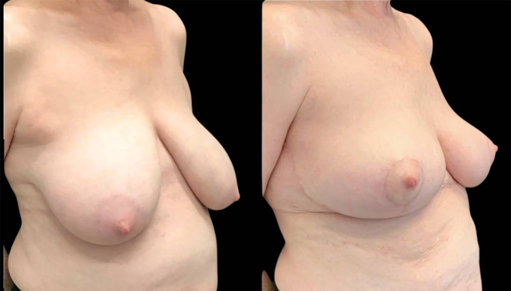 69-year-old-female-breast-lift-before-and-after-three-quarter-view.jpg