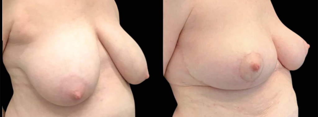 This is a 69-year-old female that has had an arm lift after weight loss showing the before and after's side-by-side