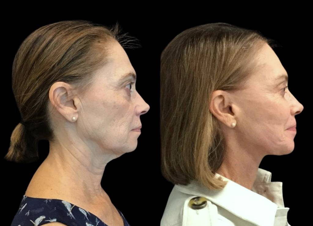 69-year-old-female-facelift-before-and-after-side-view.jpg