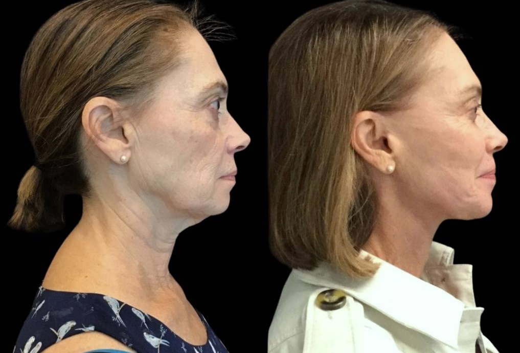 69-year-old-female-facelift-before-and-after-side-view.jpg