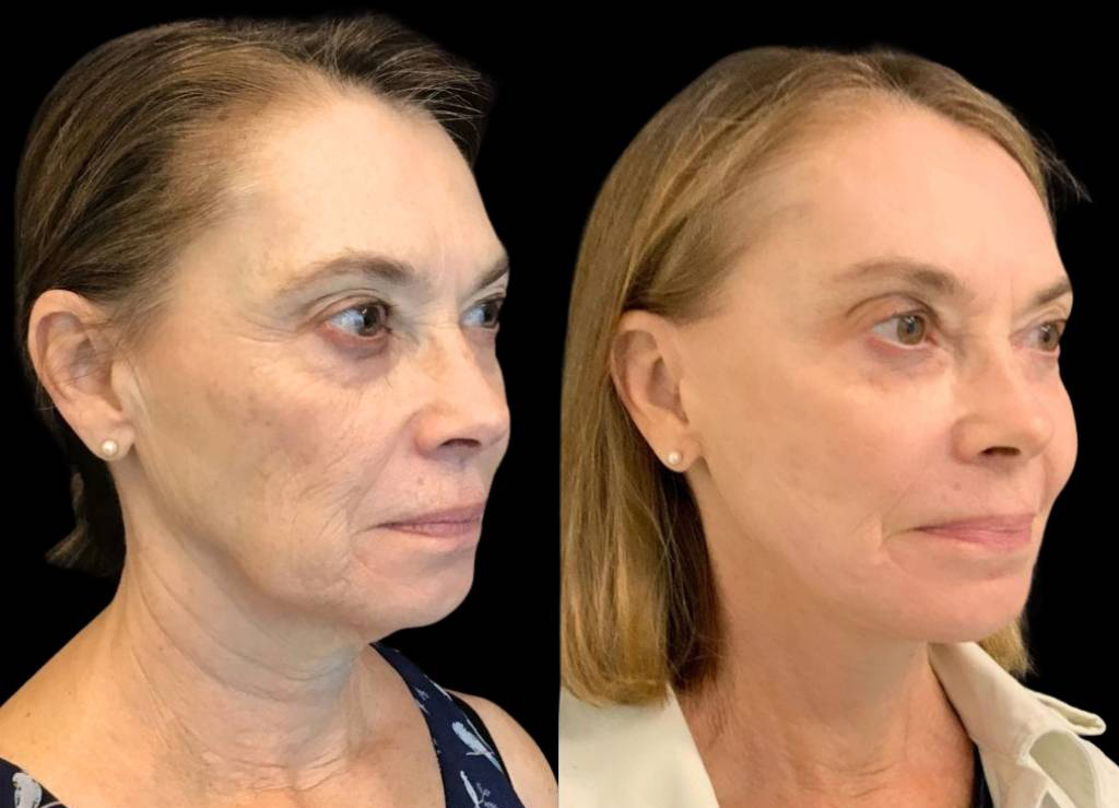 69-year-old-female-facelift-before-and-after-three-quarter-view-28546.jpg