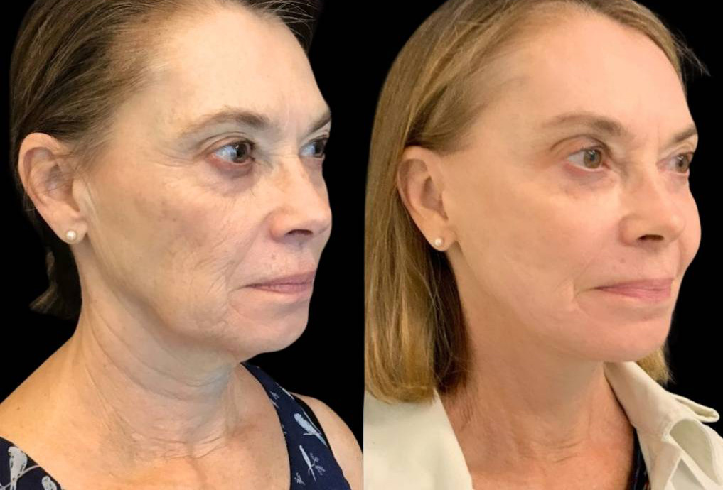 69-year-old-female-facelift-before-and-after-three-quarter-view-28546.jpg