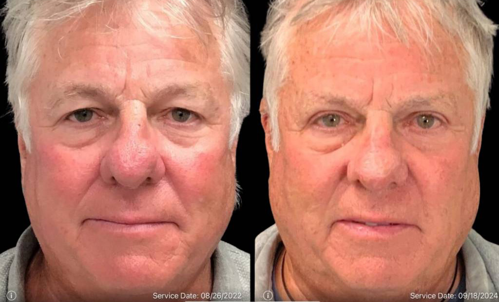69-year-old-male-rhinophyma-reduction-before-and-after-front-view-35208.jpg