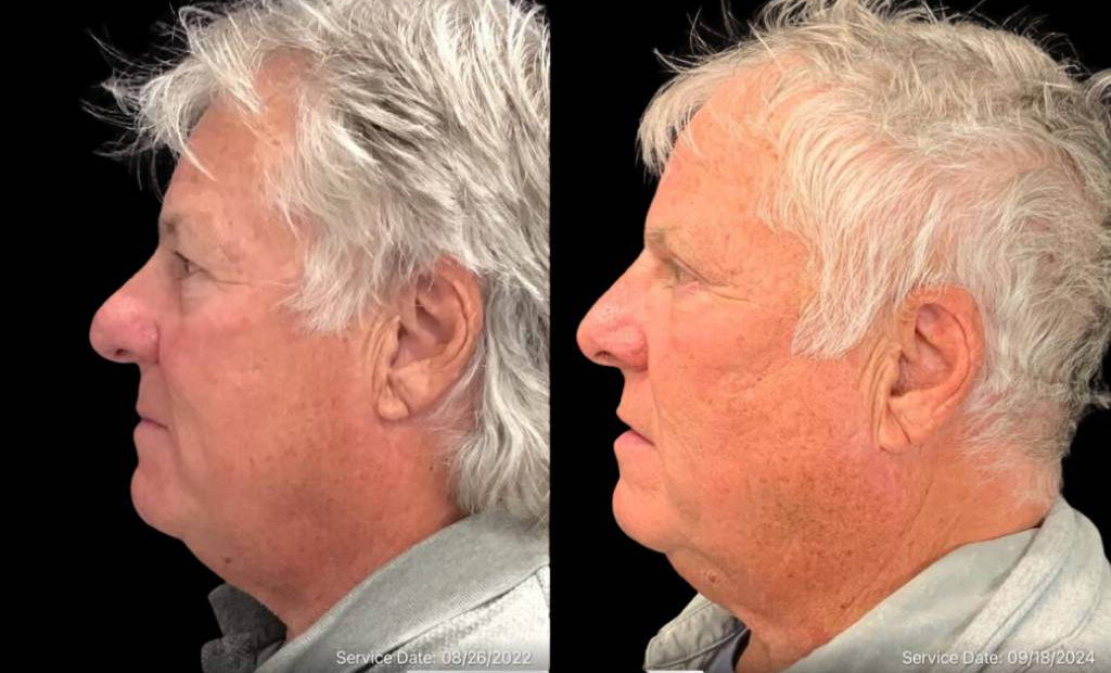 69-year-old-male-rhinophyma-reduction-before-and-after-side-view.jpg