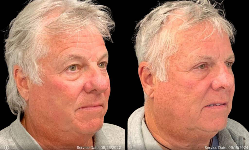 69-year-old-male-rhinophyma-reduction-before-and-after-three-quarter-view-2.jpg