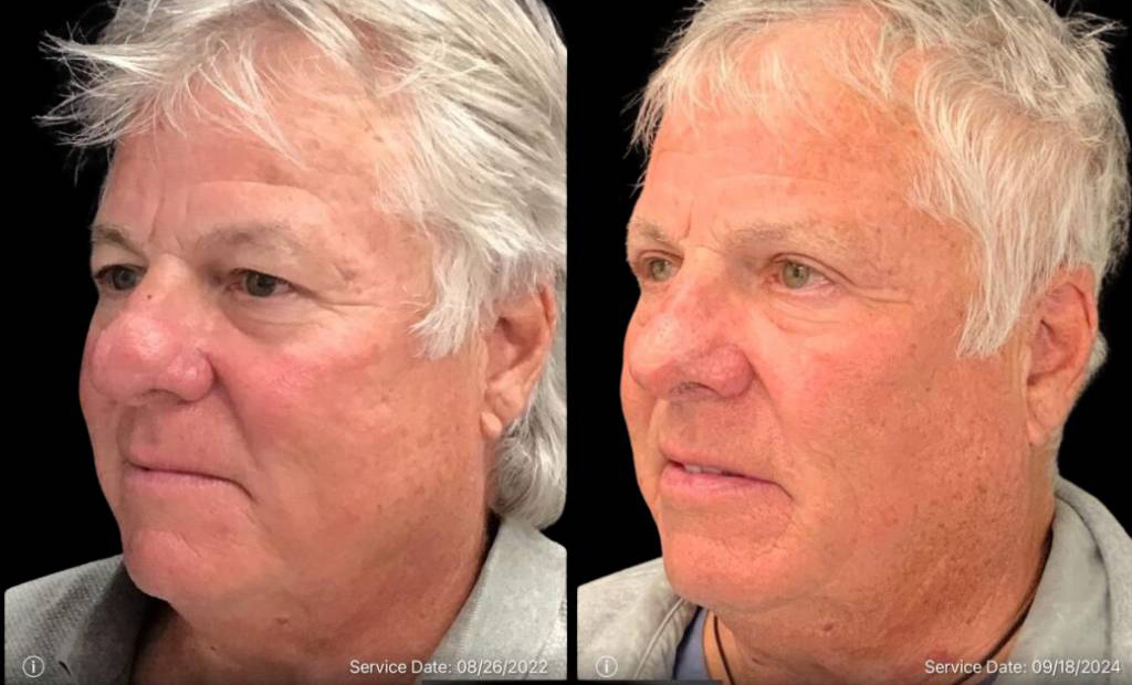 69-year-old-male-rhinophyma-reduction-before-and-after-three-quarter-view.jpg