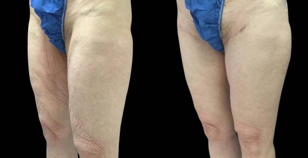69-year-old-male-thigh-lift-before-and-after-three-quarter-view.jpg