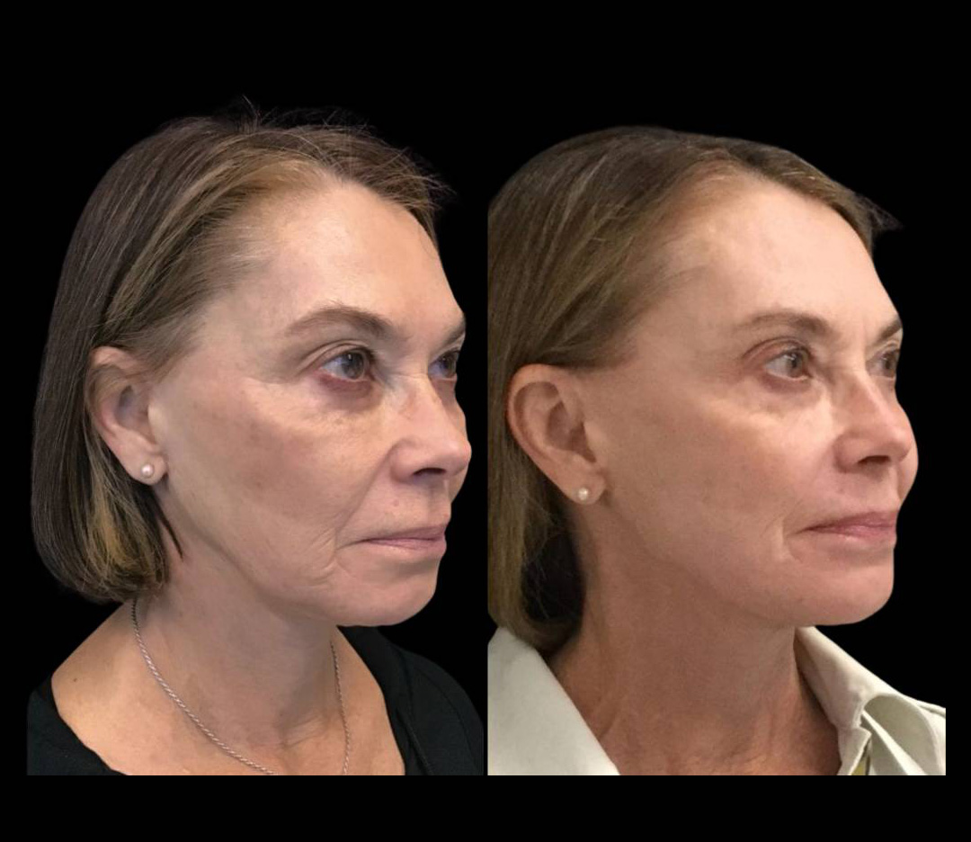 70-year-old-female-fractional-co2-laser-before-and-after-three-quarter-view-28546.jpg