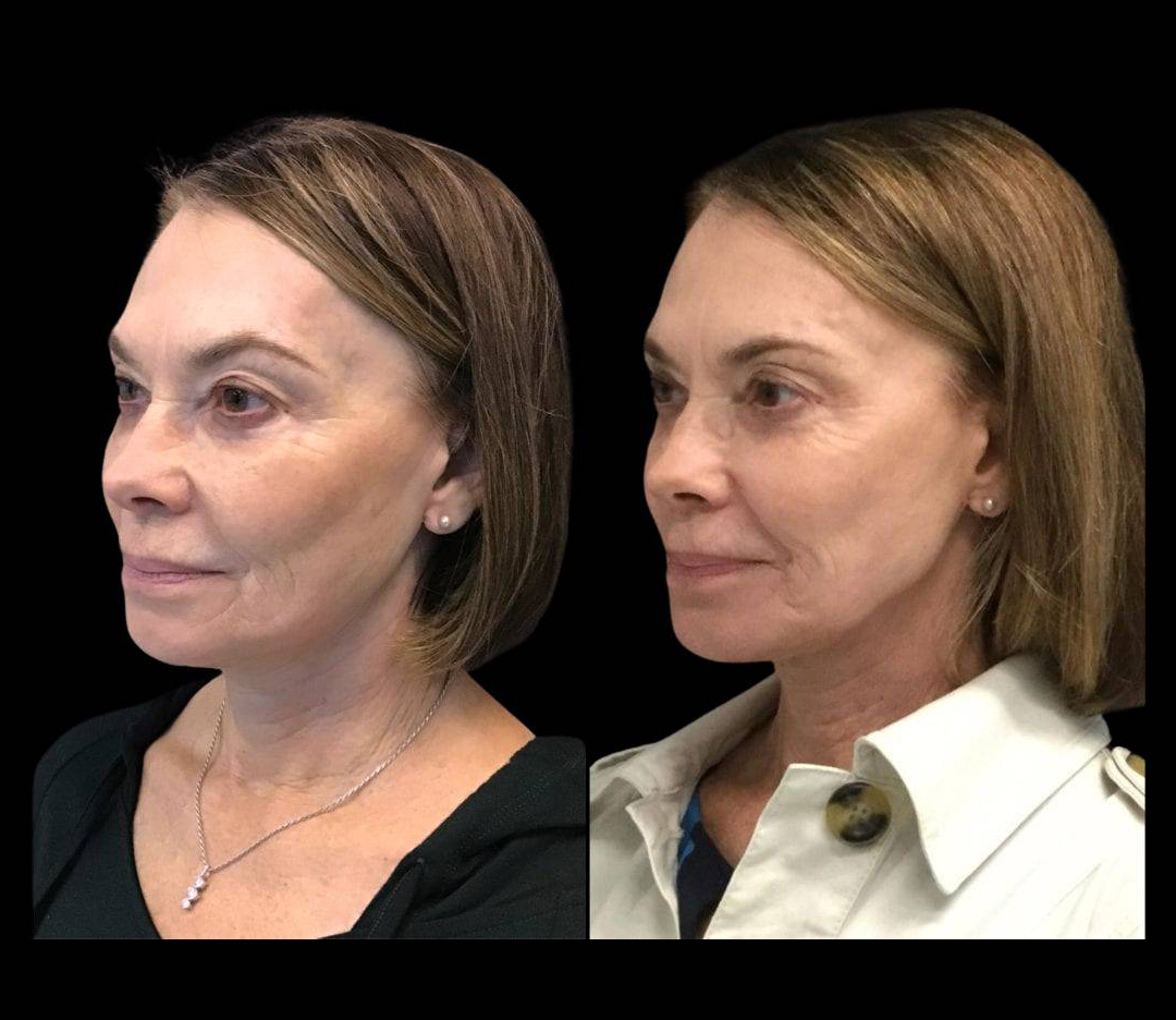70-year-old-female-fractional-co2-laser-before-and-after-three-quarter-view.jpg