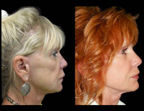 70-year-old-female-non-surgical-cheek-augmentation-before-and-after-1.jpg