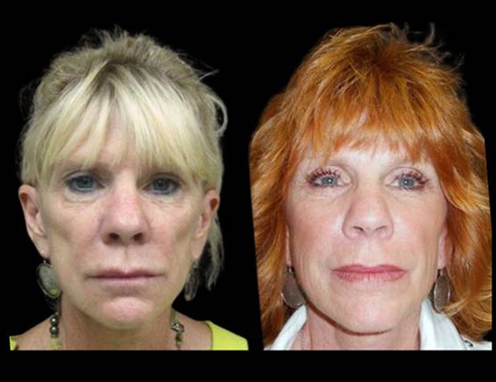 70-year-old-female-non-surgical-cheek-augmentation-before-and-after.jpg