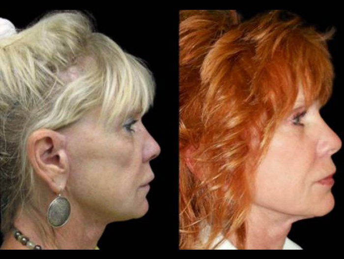 70-year-old-female-non-surgical-cheek-augmentation-before-and-after-1.jpg