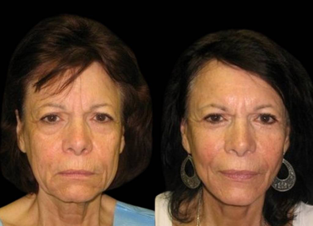 71-year-old-female-facelift-before-and-after-front-view.jpg