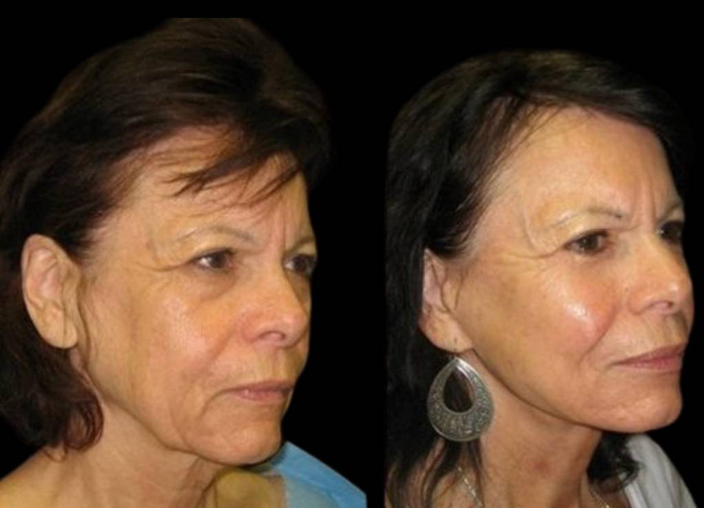 71-year-old-female-facelift-before-and-after-three-quarter-view-9277.jpg