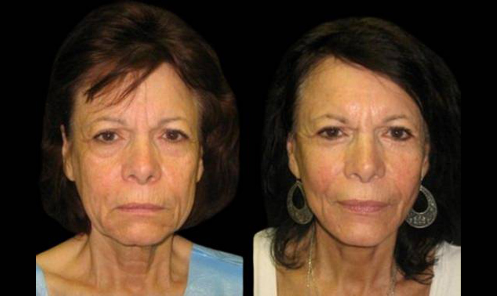 71-year-old-female-lower-eyelid-lift-before-and-after-front-view-9277.jpg
