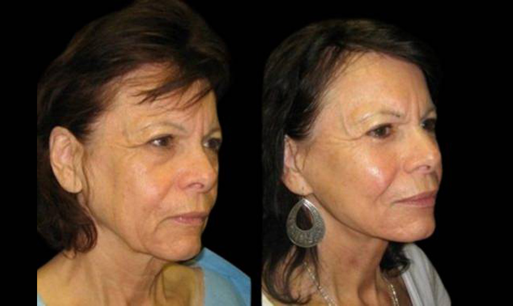 71-year-old-female-lower-eyelid-lift-before-and-after-front-view.jpg