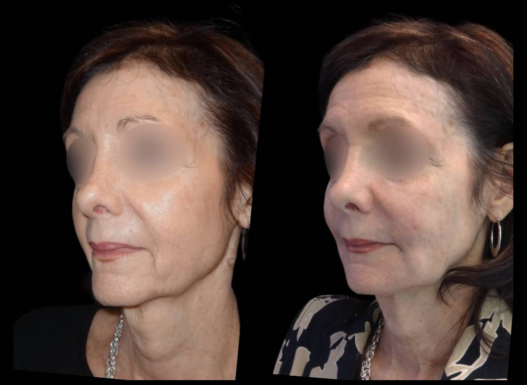71-year-old-female-non-surgical-cheek-augmentation-before-and-after-1.jpg