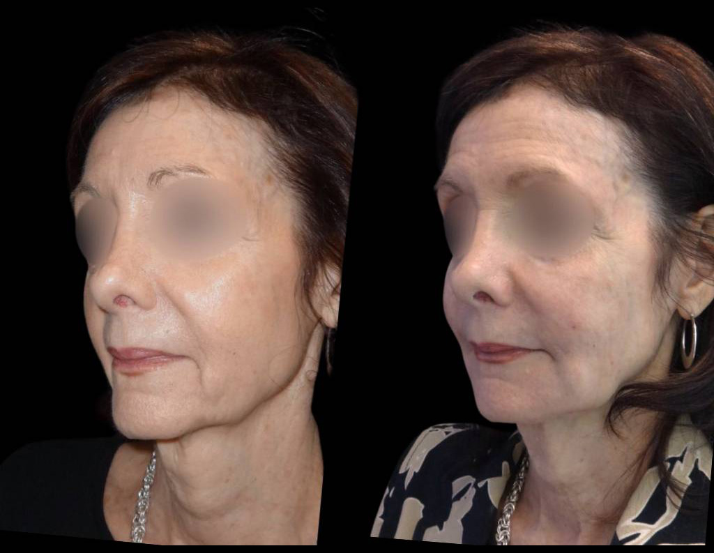 71-year-old-female-non-surgical-cheek-augmentation-before-and-after-1.jpg