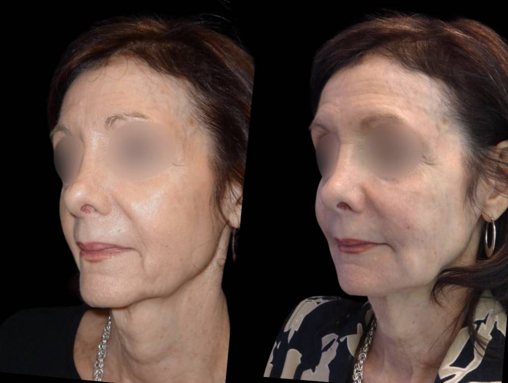 71-year-old-female-non-surgical-cheek-augmentation-before-and-after-1.jpg