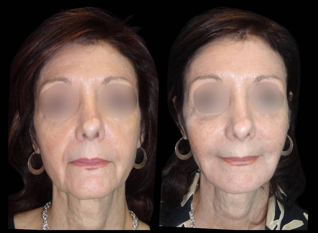 71-year-old-female-non-surgical-cheek-augmentation-before-and-after.jpg