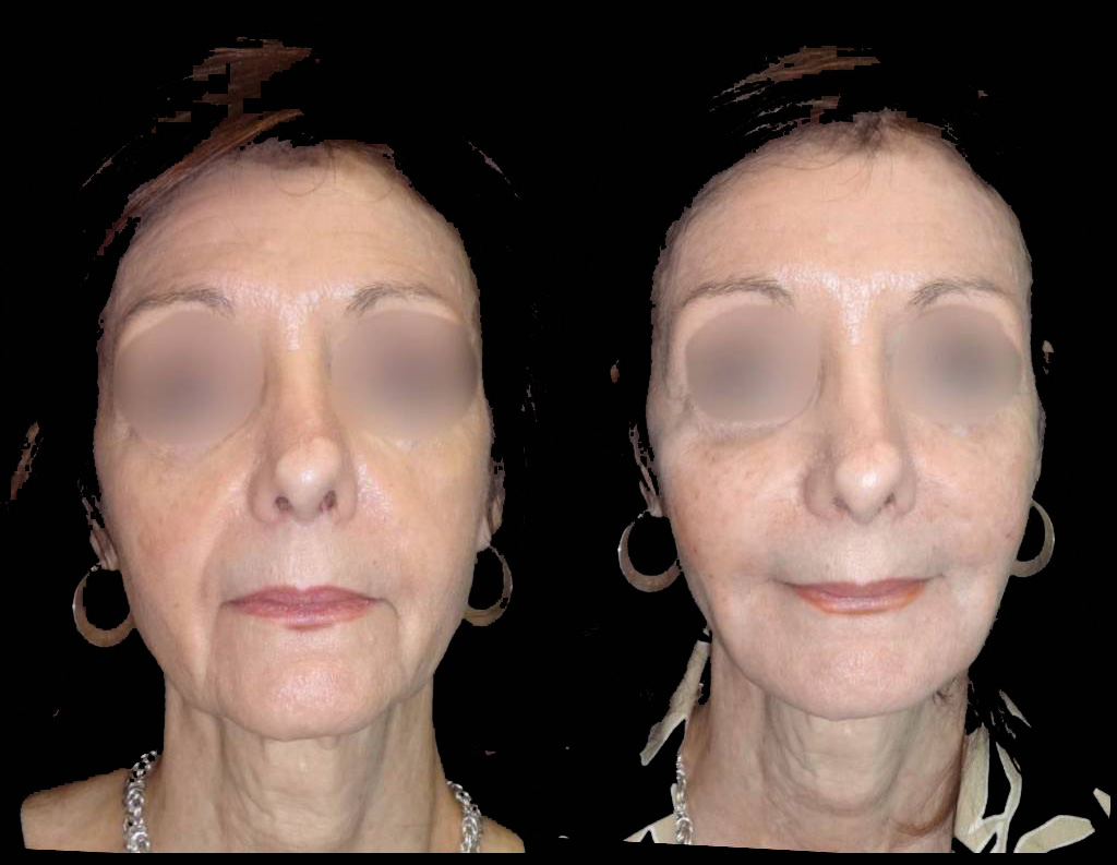 71-year-old-female-non-surgical-cheek-augmentation-before-and-after.jpg
