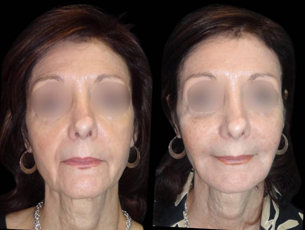 71-year-old-female-non-surgical-cheek-augmentation-before-and-after.jpg