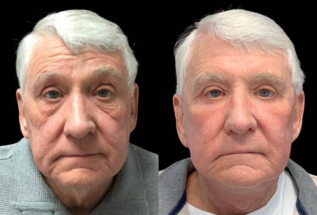 71-year-old-male-fat-grafting-before-and-after-front-view.jpg