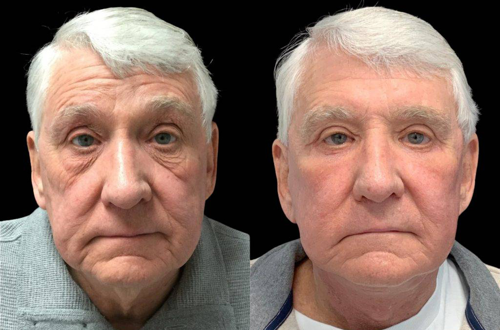 71-year-old-male-fat-grafting-before-and-after-front-view.jpg