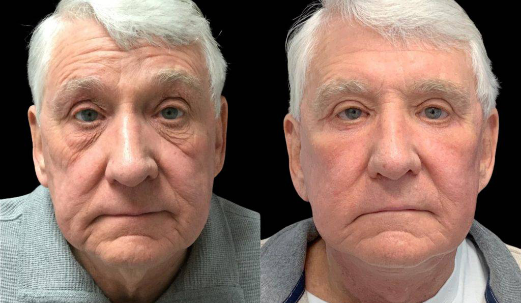 71-year-old-male-fat-grafting-before-and-after-front-view.jpg
