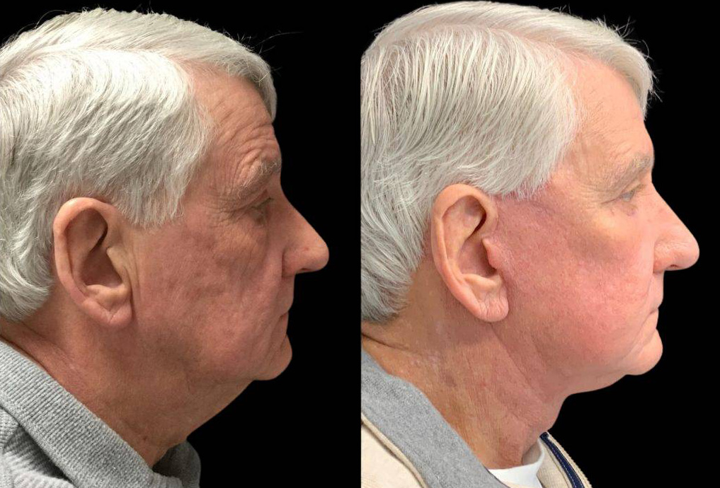 71-year-old-male-fat-grafting-before-and-after-side-view.jpg