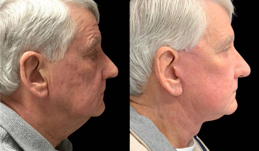 71-year-old-male-fat-grafting-before-and-after-side-view.jpg