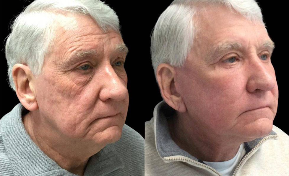 71-year-old-male-fat-grafting-before-and-after-three-quarter-view.jpg