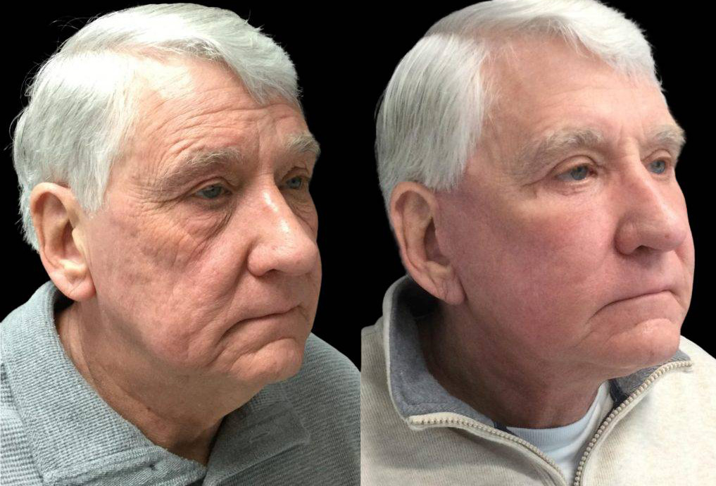 71-year-old-male-fat-grafting-before-and-after-three-quarter-view.jpg