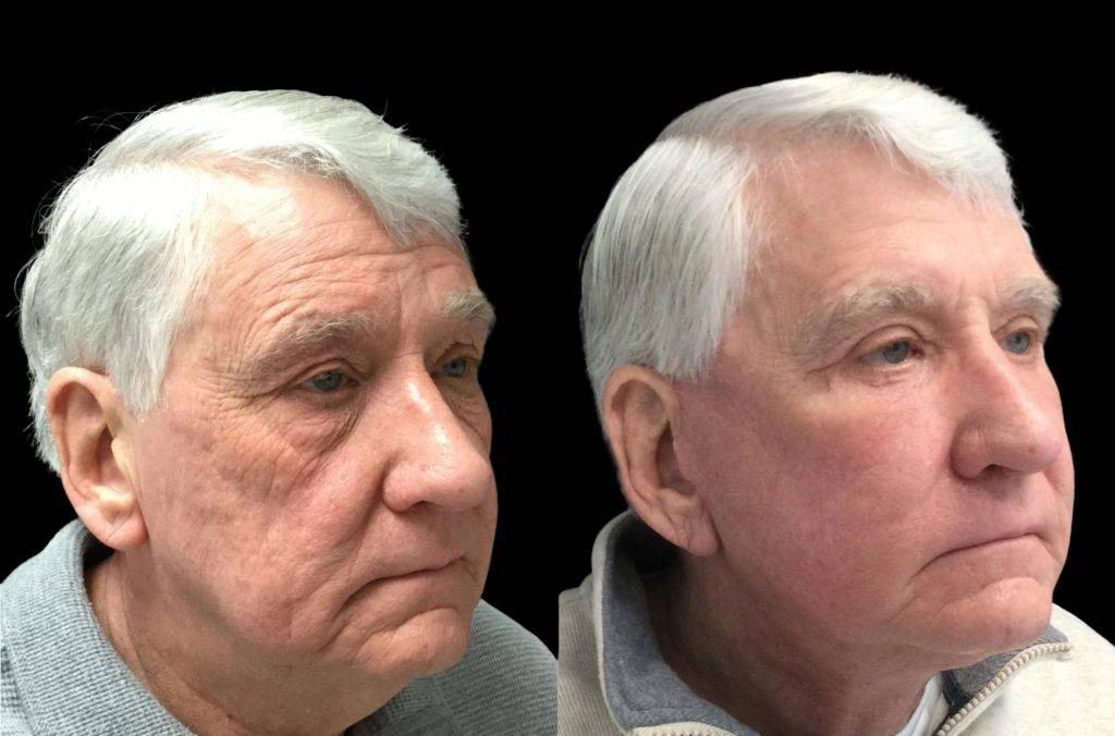 71-year-old-male-fat-grafting-before-and-after-three-quarter-view.jpg