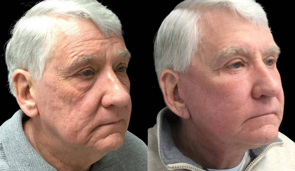 71-year-old-male-fat-grafting-before-and-after-three-quarter-view.jpg