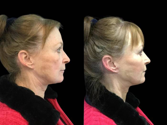 72-year-old-female-non-surgical-cheek-augmentation-before-and-after-side-view.jpg