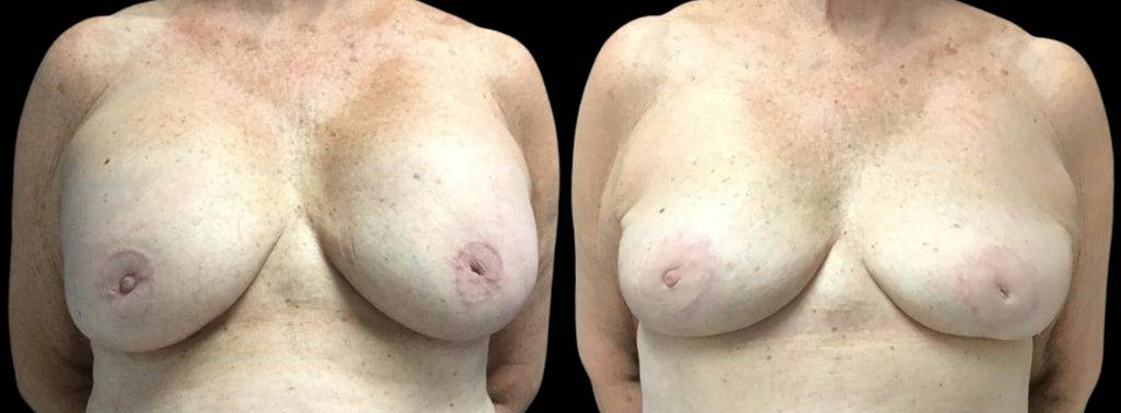This is a 73-year-old female that has had a breast lift showing the before and after's side-by-side