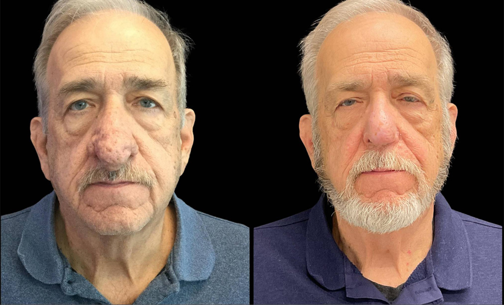 73-yr-old-male-rhinophyma-before-and-after-front-view.jpg