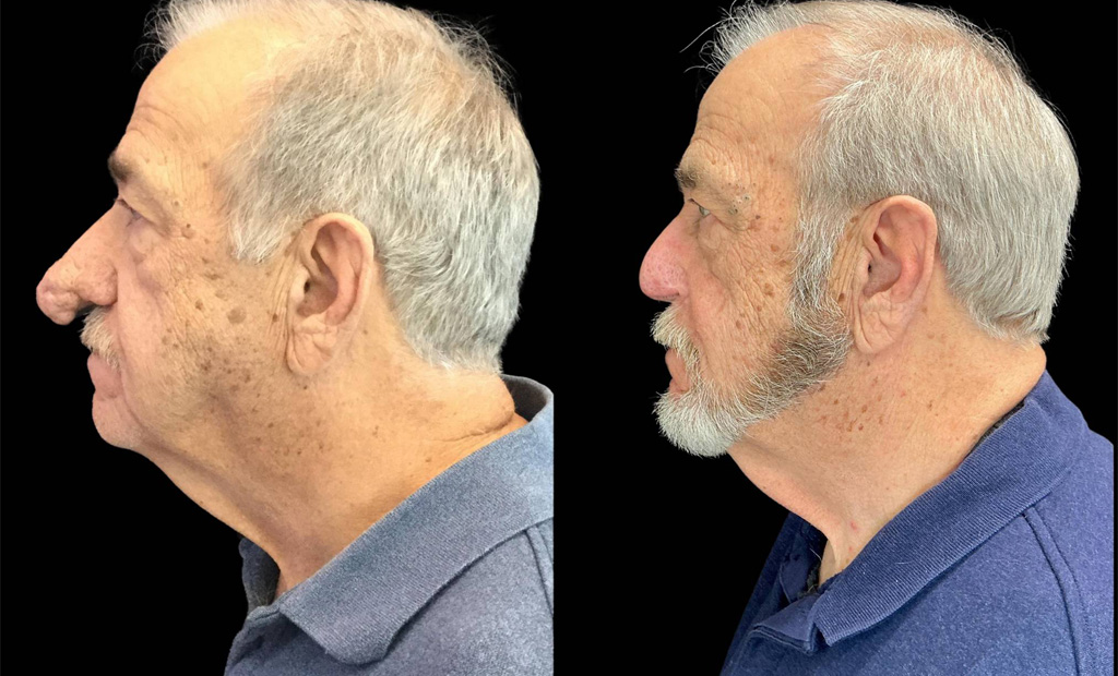 73-yr-old-male-rhinophyma-before-and-after-left-view.jpg