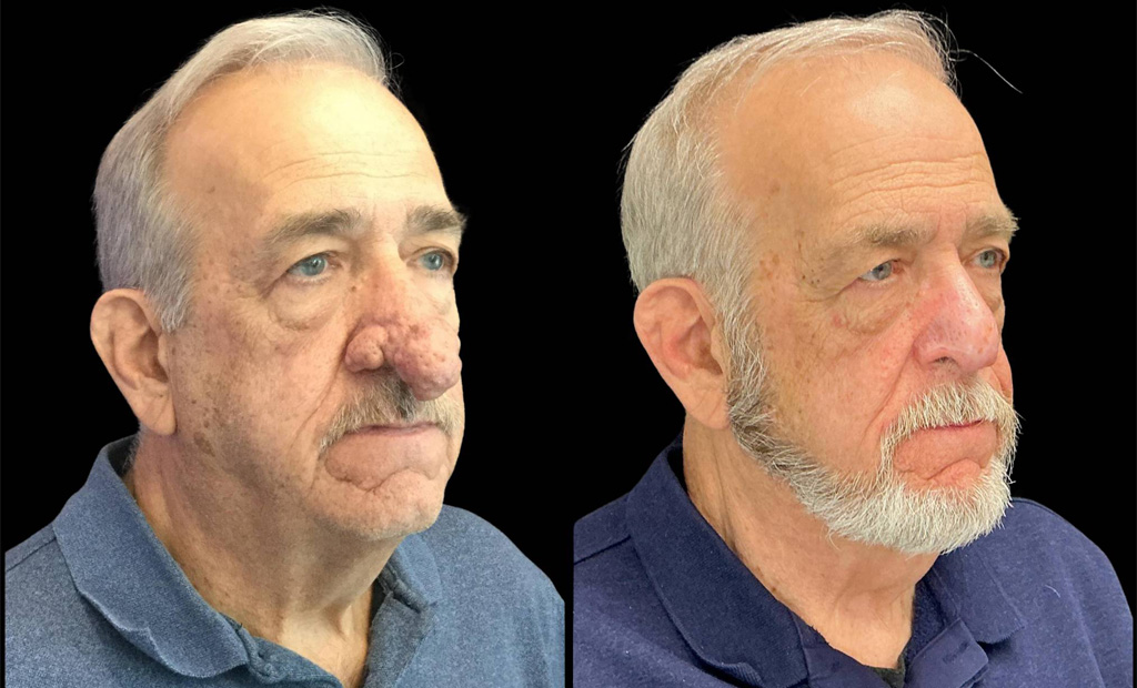 73-yr-old-male-rhinophyma-before-and-after-right-three-quarter-view.jpg